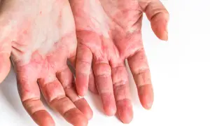 Mani arrossate e screpolate, possibili sintomi di un'allergia all'acido citrico.