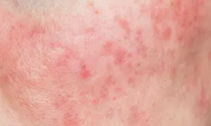 Pelle arrossata e irritata, con piccole macchie rosse, sintomo di un'allergia ammorbidente.
