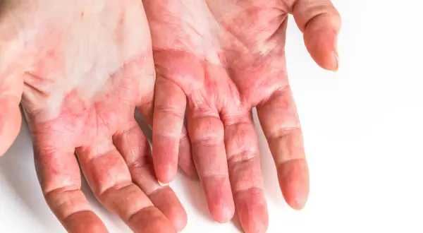 Mani arrossate e screpolate, possibili sintomi di un'allergia all'acido citrico.
