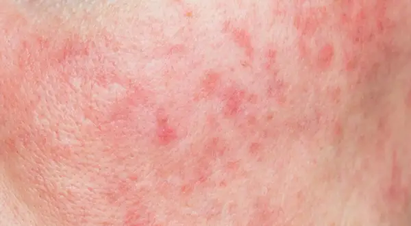 Pelle arrossata e irritata, con piccole macchie rosse, sintomo di un'allergia ammorbidente.