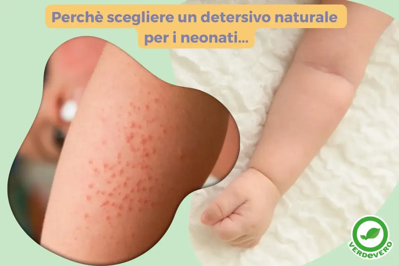 Pelle irritata di un neonato. Scopri come lavare i vestiti dei neonati in lavatrice con detergenti naturali per evitare arrossamenti.