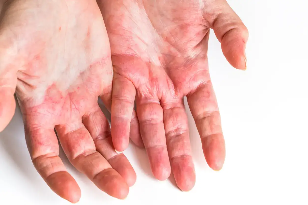 Mani arrossate e screpolate, segno di una possibile allergia ammorbidente.
