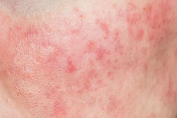 Pelle arrossata e irritata, con piccole macchie rosse, sintomo di un'allergia ammorbidente.
